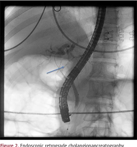 Figure 1 From Neuroendocrine Carcinoma Of The Extrahepatic Bile Ducts