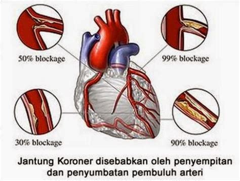 Terapi Non Farmakologi Penyakit Jantung Koroner