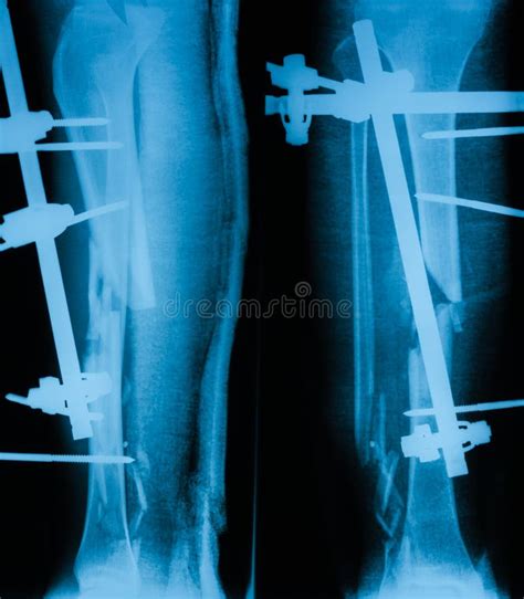 X Ray Image Of Broken Leg AP And Lateral View Stock Photo Image Of