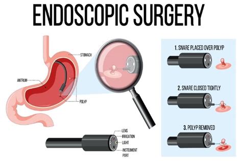 Endoscopy Explained Procedure Benefits And Recovery Marinas Clinic