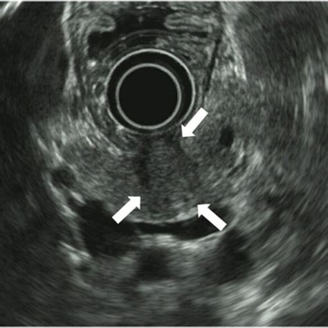 Eus Scan Findings The Tumor Is Visualized As A Hypoechoic Mass White Download Scientific