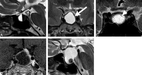 Craniopharyngioma And Pituitary Adenoma