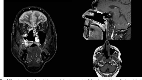 Figure 3 From Poorly Differentiated Sarcoma Of The Maxillary Sinus A