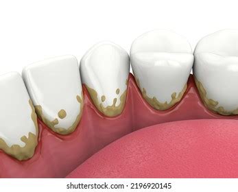 3d Render Lower Jaw Calculus Buildup Stock Illustration 2196920145 ...