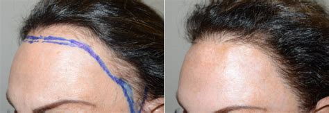 Hair Transplants For Women Photos Miami Fl Patient108716