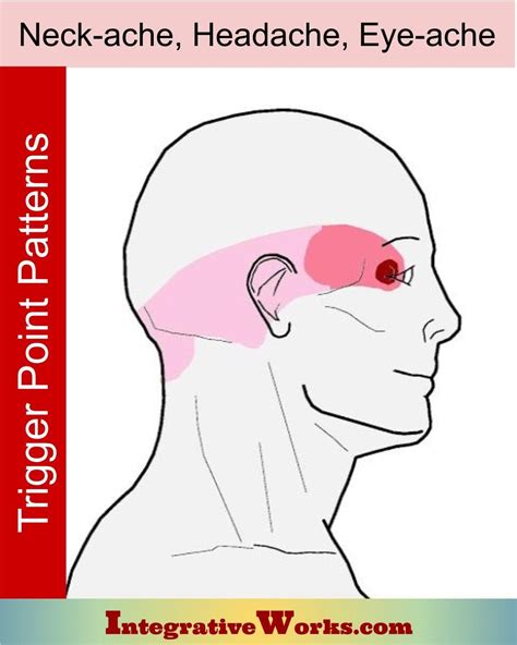 Sinus headache and stiff neck images | aboutheadache