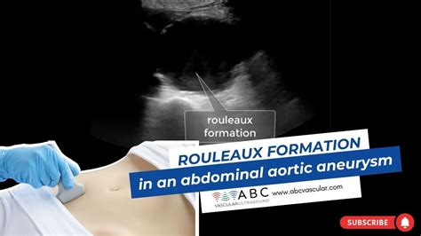 Rouleaux Formation In An Abdominal Aortic Aneurysm Abc Vascular