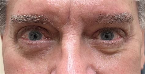 24 Eyelid Surgery Before And After Photos Dallas Plano Texas Cosmetic Reconstructive Eye Surgery