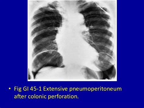 45 Pneumoperitoneum