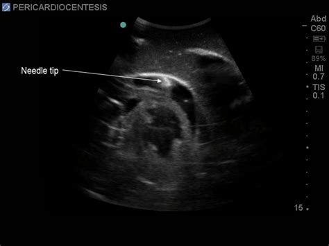 Transthoracic Echocardiography And Pericardiocentesis Ultrasound