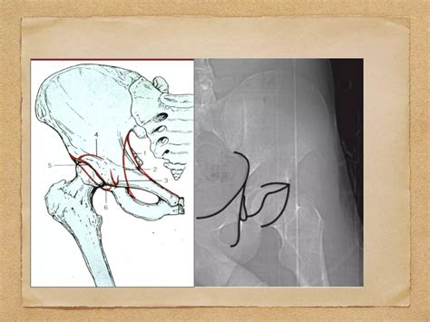 Acetabular Fracture Radiology: Xrays, CT scan & 3D printing | PPT