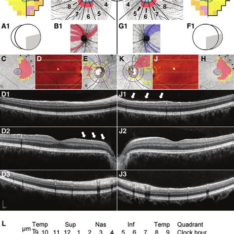 Reconciling Retinal Ganglion Cell And Retinal Nerve Fibre Layer Loss