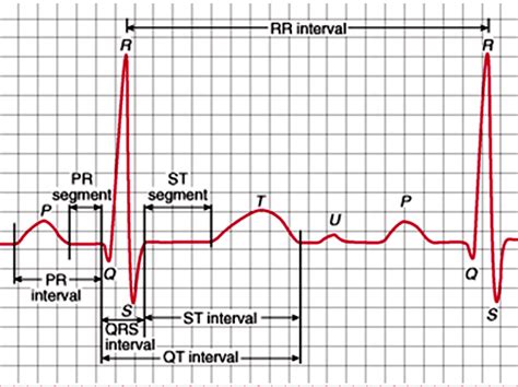 Que Représente le Signal ECG AVF Biomedical