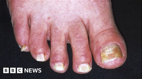 Toenail Fungus Found To Be Asexual In Humans Bbc News