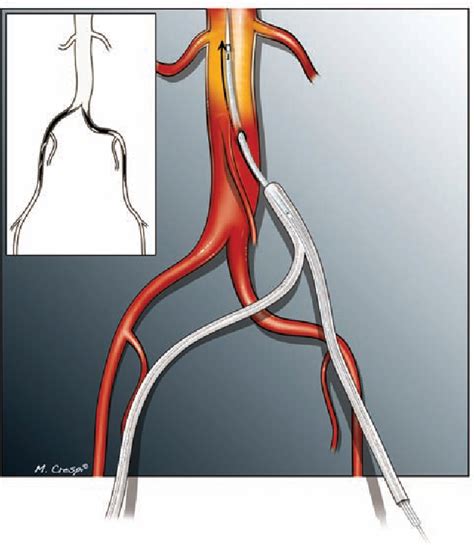 Figure 2 From New Development For Aorto Bifemoral Bypass A Clampless And Sutureless