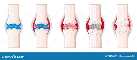 Rhumatisme Articulaire Au Corps Humain Illustration De Vecteur