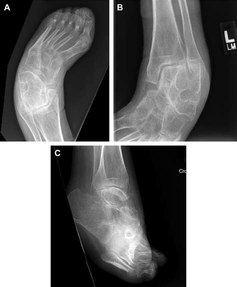 Triple Arthrodesis Foot And Ankle Clinics