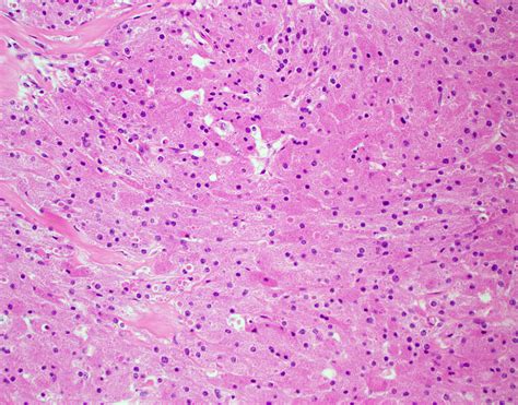 Neurogenic Tumours Of The Posterior Mediastinum And Differential