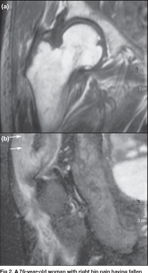 Figure 2 From Early Magnetic Resonance Imaging Of Radiographically