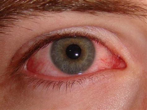 Allergies Or Pink Eye