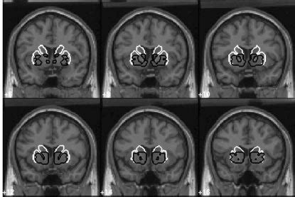 Regions of interest. The ventral striatum is shown in black, and the ...