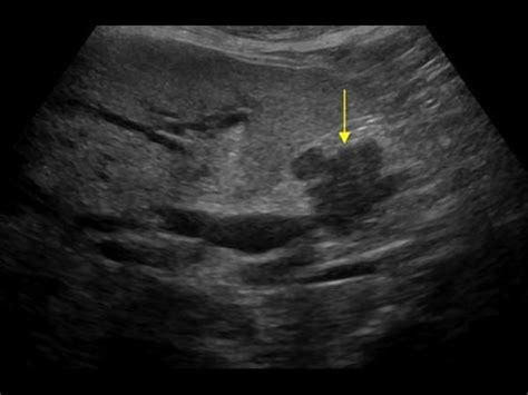 Pin By Dang Hang On Pancreas Ultrasound Sonography Ultrasound