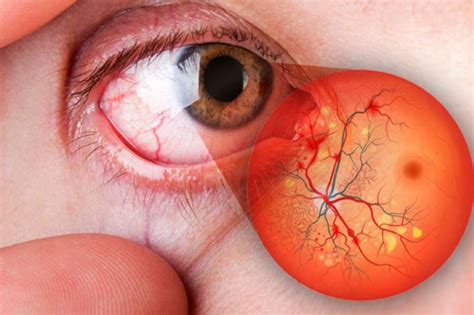 Explorando la Retinopatía Diabética Causas Síntomas y Tratamientos