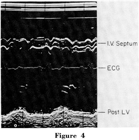 Paradoxical Motion Of Interventricular Septum In Left Bundle Branch