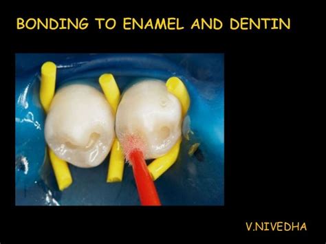 Bonding To Enamel And Dentin