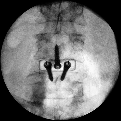 Centinel Spine For Prodisc Motion Preservation Disc Arthroplasty And