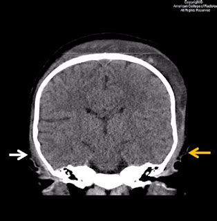 RADIOLOGY IMAGE SPOTTERS Subgaleal Hemorrhage