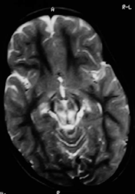 Axial T2 Weighted MR Image At The Level Of Midbrain Showing