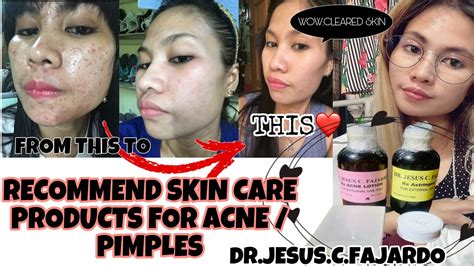 Recommended Skin Care Dermatologist Product For Acne Pimple By Dr