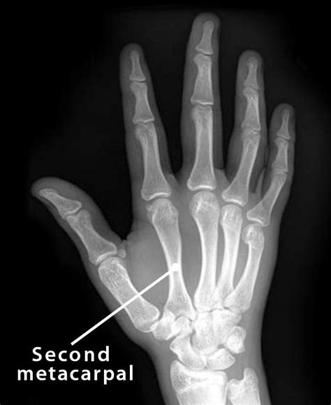 Second Metacarpal Definition Location Anatomy Diagram