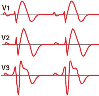 Brugada syndróm EKG kniha TECHmED