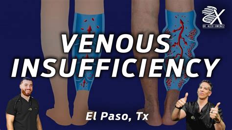 What You Need To Know About Venous Insufficiency El Paso Back Clinic