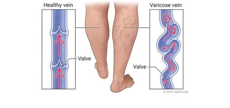 Everything You Need To Know About Varicose Veins Vein And