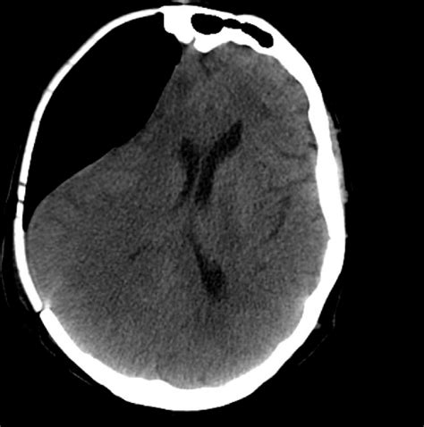 Figure From Tension Pneumocephalus A Rare Complication Of