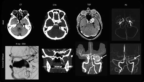 Pre Operative Computed Tomography Ct Ct Angiography Cta Digital Download Scientific