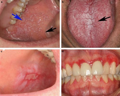 Oral Lichenoid Lesions Distinguishing The Benign From The Deadly