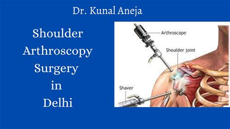 Shoulder Arthroscopy Surgery In Delhi Dr Kunal Aneja