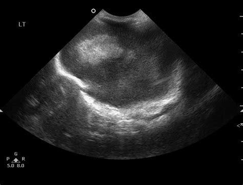 Germinal Matrix Hemorrhage Grade Iv Image Radiopaedia Org