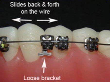 Reidsville Orthodontics Broken Braces