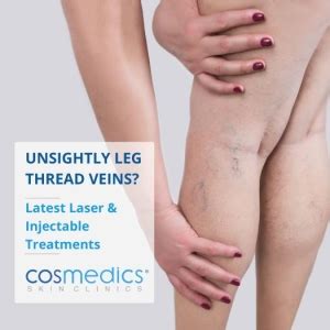 Unsightly Leg Thread Veins London Vein Centre