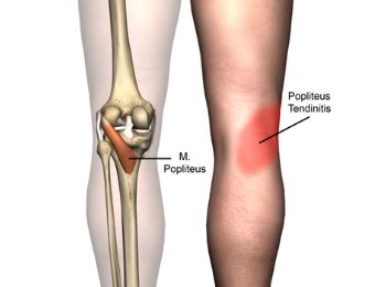 Popliteus Injury - Motion Health Centre