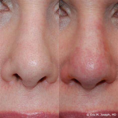 Eric M Joseph Md Permanent Non Surgical Rhinoplasty Nose Job