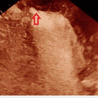 Flail Anterior Leaflet Due To Posteromedial Papillary Muscle Rupture