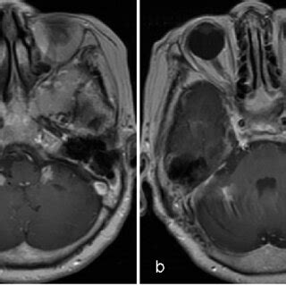 A Initial T Weighted Magnetic Resonance Imaging With Gadolinium