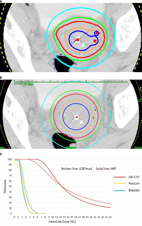 Frontiers Combined Interstitial And Intracavitary High Dose Rate