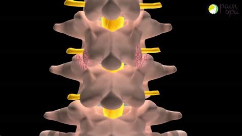 Lumbar Facet Joint Injection Under X Ray Guidance Youtube